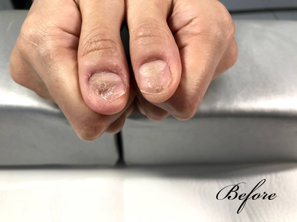 ネイルサロンS-nail深爪矯正・自爪育成イメージ