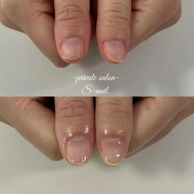 .
初回▷▶︎▷3回目施術後
————————————————————
‪

- 深爪矯正/自爪育成に特化したsalon -
.
深爪噛み癖むしり癖凹凸のあるお爪に
お悩みの方ぜひ一度ご相談ください。
.
.
▫️大阪/天王寺区　各線天王寺駅徒歩3分
▫️10:30〜18:00
▫️LINE  @855rjbic
▫️定休日⤑日曜日・月曜日

@fukazume_s_nail
@s_nail0601
private salon S-nail. 

————————————————————

#深爪矯正#深爪育成
#自爪育成#自爪育成サロン
#天王寺ネイルサロン