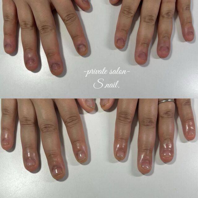 .
初回▷▶︎▷2回目施術後
————————————————————
‪

- 深爪矯正/自爪育成に特化したsalon -
.
深爪噛み癖むしり癖凹凸のあるお爪に
お悩みの方ぜひ一度ご相談ください。
.
.
▫️大阪/天王寺区　各線天王寺駅徒歩3分
▫️10:30〜18:00
▫️LINE  @855rjbic
▫️定休日⤑日曜日・月曜日

@fukazume_s_nail
@s_nail0601
private salon S-nail. 

————————————————————

#深爪矯正#深爪育成
#自爪育成#自爪育成サロン
#天王寺ネイルサロン