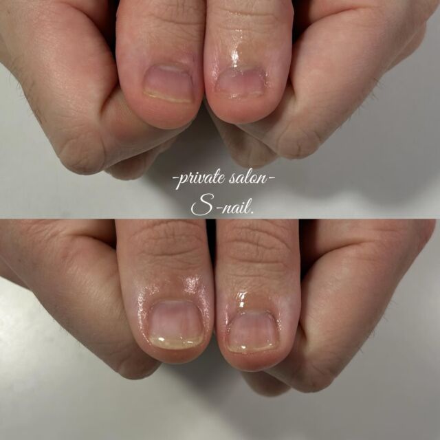 .
初回▷▶︎▷2回目施術後
————————————————————
‪

- 深爪矯正/自爪育成に特化したsalon -
.
深爪噛み癖むしり癖凹凸のあるお爪に
お悩みの方ぜひ一度ご相談ください。
.
.
▫️大阪/天王寺区　各線天王寺駅徒歩3分
▫️10:30〜18:00
▫️LINE  @855rjbic
▫️定休日⤑日曜日・月曜日

@fukazume_s_nail
@s_nail0601
private salon S-nail. 

————————————————————

#深爪矯正#深爪育成
#自爪育成#自爪育成サロン
#天王寺ネイルサロン